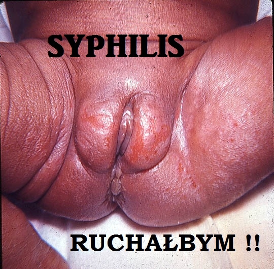 syphilis